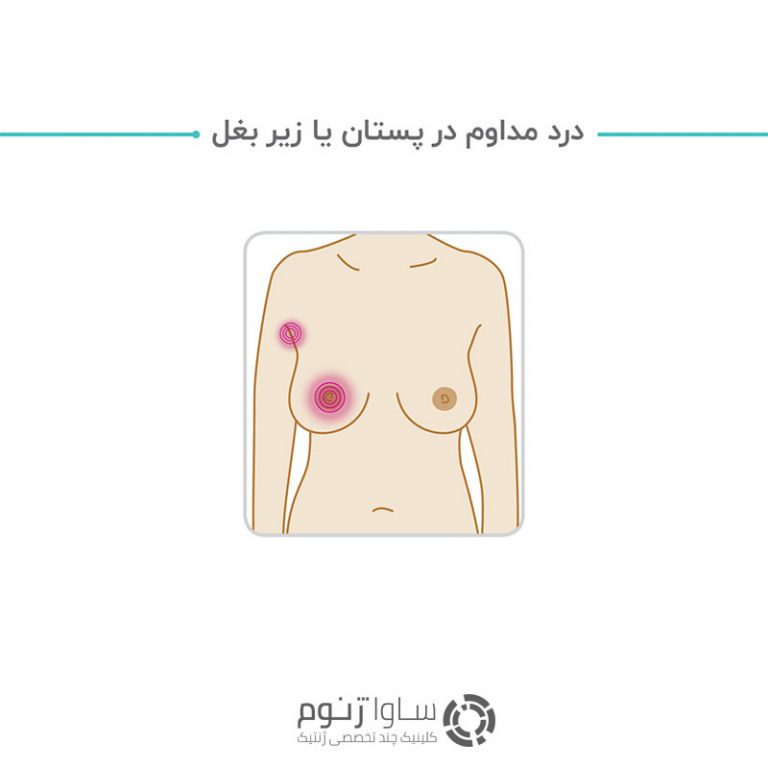 درد مداوم در پستان یا زیر بغل