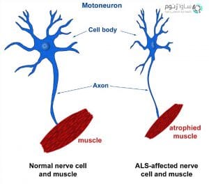عصبی موتور نورون بیماری ALS